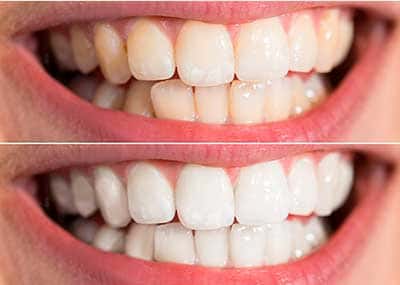 blanqueamiento-dental