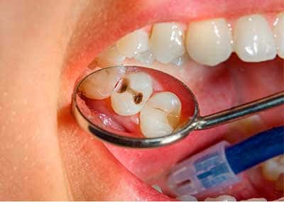 caries-obturacion