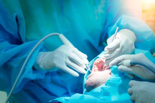 Cirugía Periodontal en Benalmádena