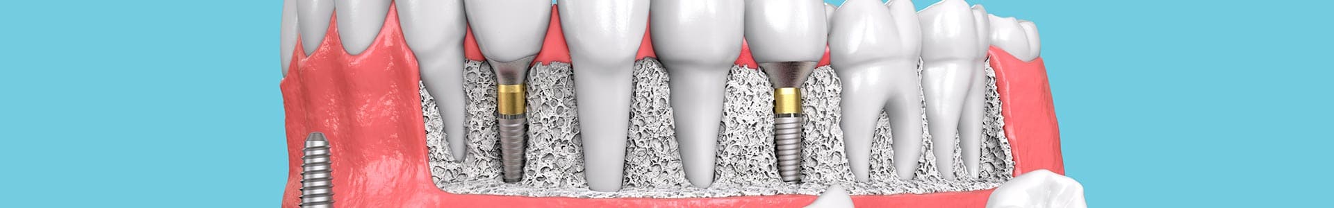 Implantes dentales en Benalmádena