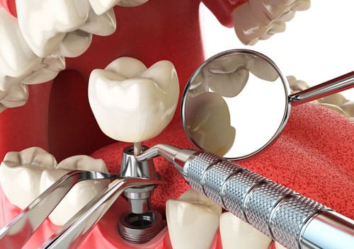 Tratamiento implantes dentales en Benalmádena implantes dentales sin dolor en Benalmádena