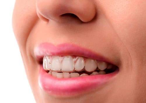 Invisalign en Benalmádena Ortodoncia con Invisalign en Benalmádena