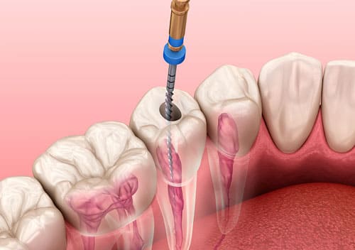 Matar el nervio de la muela en Benalmádena