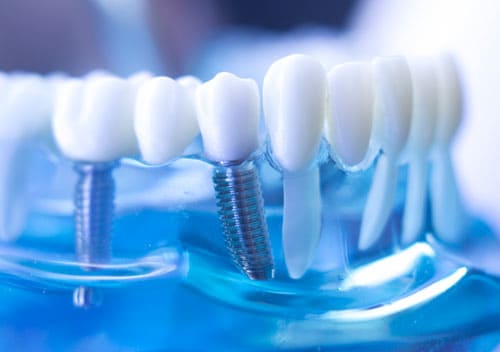 implantes con raíces de titanio Implantología con raíces de titanio en Benalmádena